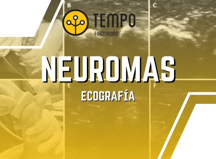 neuromas-y-ecografia